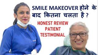 SMILE MAKEOVER होने के बाद कितना चलता है ? - Honest Review Patient Testimonial