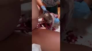 Breech birth in the mountains of Mexico