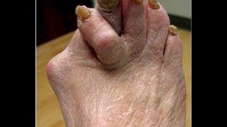 Ugly Feet - Watch if you dare