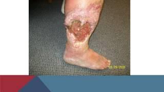 Lymphedema A to Z