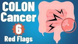 Colon cancer 6 EARLY symptoms & why they occur  Colon cancer symptoms  colorectal cancer