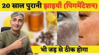 How to treat PIGMENTATION I Natural remedies for pigmentation I Melasma Treatment I DR  MANOJ DAS