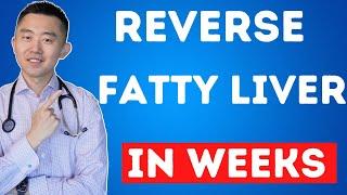 The FASTEST Way to Reverse Fatty Liver Naturally  NAFLD Treatment