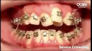 Cận cảnh răng dịch chuyển khi Niềng Răng