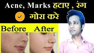 Rang saf karne ka tarika  Acne  pimple dark circle  blackheads  white heads  dr tarun