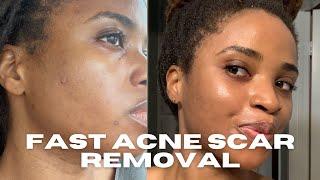 PICO laser for Hyperpigmentation  Dark Skin  Acne Scars  The Simple Farmacist