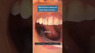 Crown removal procedure  crown removal dental  removing porcelain crown  Dr. Yazdan  #dentist
