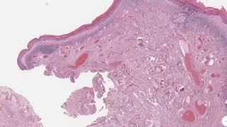 Dermatopathology Histopathology of Balanitis xerotica obliteransLichen sclerosis.