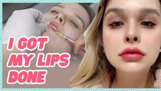 Natural Looking and Fuller Lips with Korean Lip Fillers  Step by Step Before and After