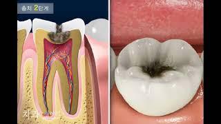 충치치료 진행 과정