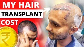 Update Hair Transplant Day 26 - Actual Cost Of My Hair Transplant  Hair Transplant Cost In India