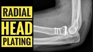 Plating of Radial Head for Radial Head and Neck Fractures