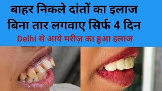 Delhi से आये मरीज़ के बाहर निकले दांतो का इलाज सिर्फ 4 दिन में बिना तार लगवाएSmile design treatment