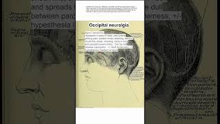 Occipital neuralgia