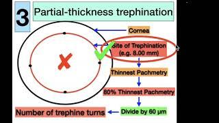 To the wonderland - Tips for Executing the Perfect Big Bubble DALK - Prof. Tarek Katamish