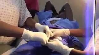 Adult male Gomco Circumcision with tissue adhesive to prevent HIV transmission