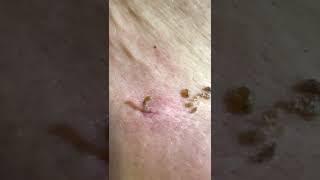 Funniest pore of winer blackhead removal with 3 toddlers commentating 