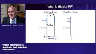 Utilizing Radiofrequency Ablation to Treat Metastatic Bone Disease A Case-Based Presentation