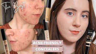 Best Concealers For ACNE PRONE SKIN  Scarring & Pigmentation  Non-Comdogenic