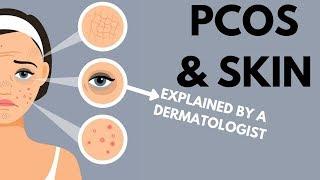 PCOS & Skin  Dermatologist Review