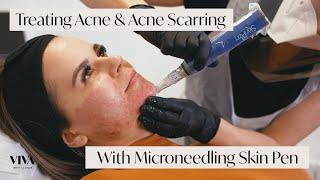 This Is Microneedling for Acne Scarring 