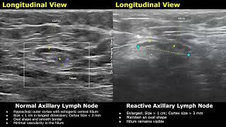 Axillary Lymph Nodes Ultrasound Normal Vs Abnormal Images With Doppler  Reactive & Malignant Nodes