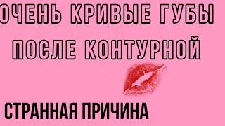 Кривые губы после #контурнаяпластикагуб Комки в губах.