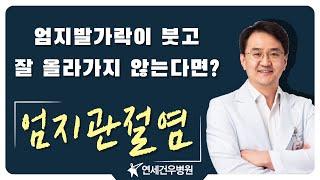 엄지관절염의 증상부터 치료까지 한 번에 엄지발가락이 붓고 잘 올라가지 않는다면 확인해 보세요