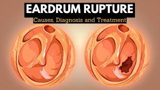 The Science Behind Eardrum Rupture Explained in Simple Terms