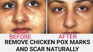 Remove chicken pox marks and scar naturally