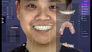 Digital Smile Design with Ray face. Try in Veneer design