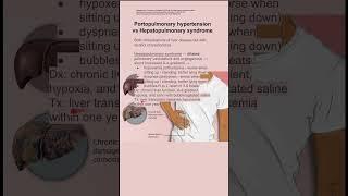 Portopulmonary hypertension vs Hepatopulmonary syndrome