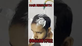 Hair growth by Hijama therapy  HIJAMA. COMDR.A K JILANI #shorts Hair growth