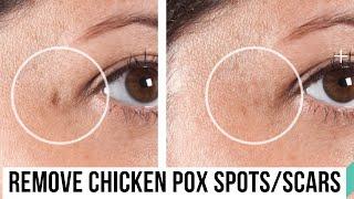 HOW TO REMOVE CHICKEN POX SPOTSSCARS  NATURALLY  works 100% by Natural beauty tips