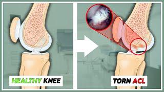 Torn ACL? Surgery vs. Conservative Treatment What You Need to Know