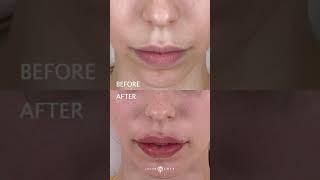  FEMALE RUSSIAN LIP AUGMENTATION WITH KEYHOLE POUT USING JUVEDERM VOLLURE  DR JASON EMER TIKTOK