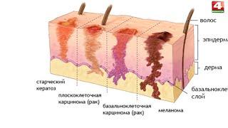 Просто о здоровье. Меланома и рак кожи. 28.09.2021