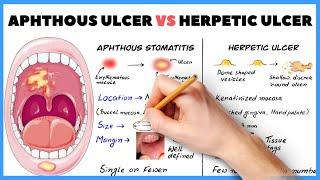 Aphthous ulcer Aphthous stomatitis vs Herpetic ulcer  How to diagnose