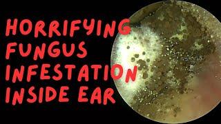 HORRIFYING Fungus Infestation Inside Ear