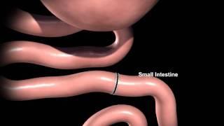 Rex Bariatrics Gastric Bypass Surgery Explained