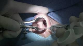 Septoplasty GRAPHIC - Deviated Septum Surgery