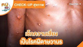 เช็กความเสี่ยงเป็นโรคฝีดาษวานร​  Check up สุขภาพ