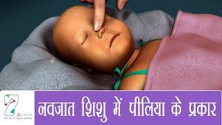 नवजात शिशु में पीलिया के प्रकार  Types of Jaundice in Newborn  Hindi