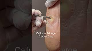 Callus With Large Central Core #calluses
