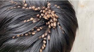 Do ticks like being in your hair?