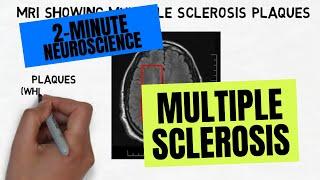 2-Minute Neuroscience Multiple Sclerosis