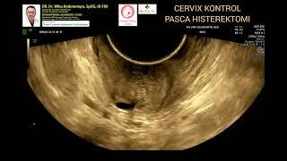 Kontrol cervix pasca histerektomi