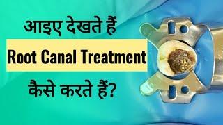 What Is Root Canal Treatment #RCT l RCT on Tooth in Hindi