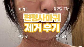 편평사마귀 제거 후기 16일차 듀오덤 Tip 까지