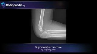 Supracondylar fracture - radiology video tutorial x-ray